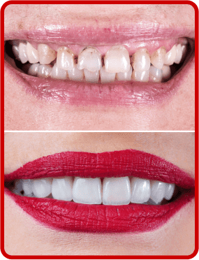 before after